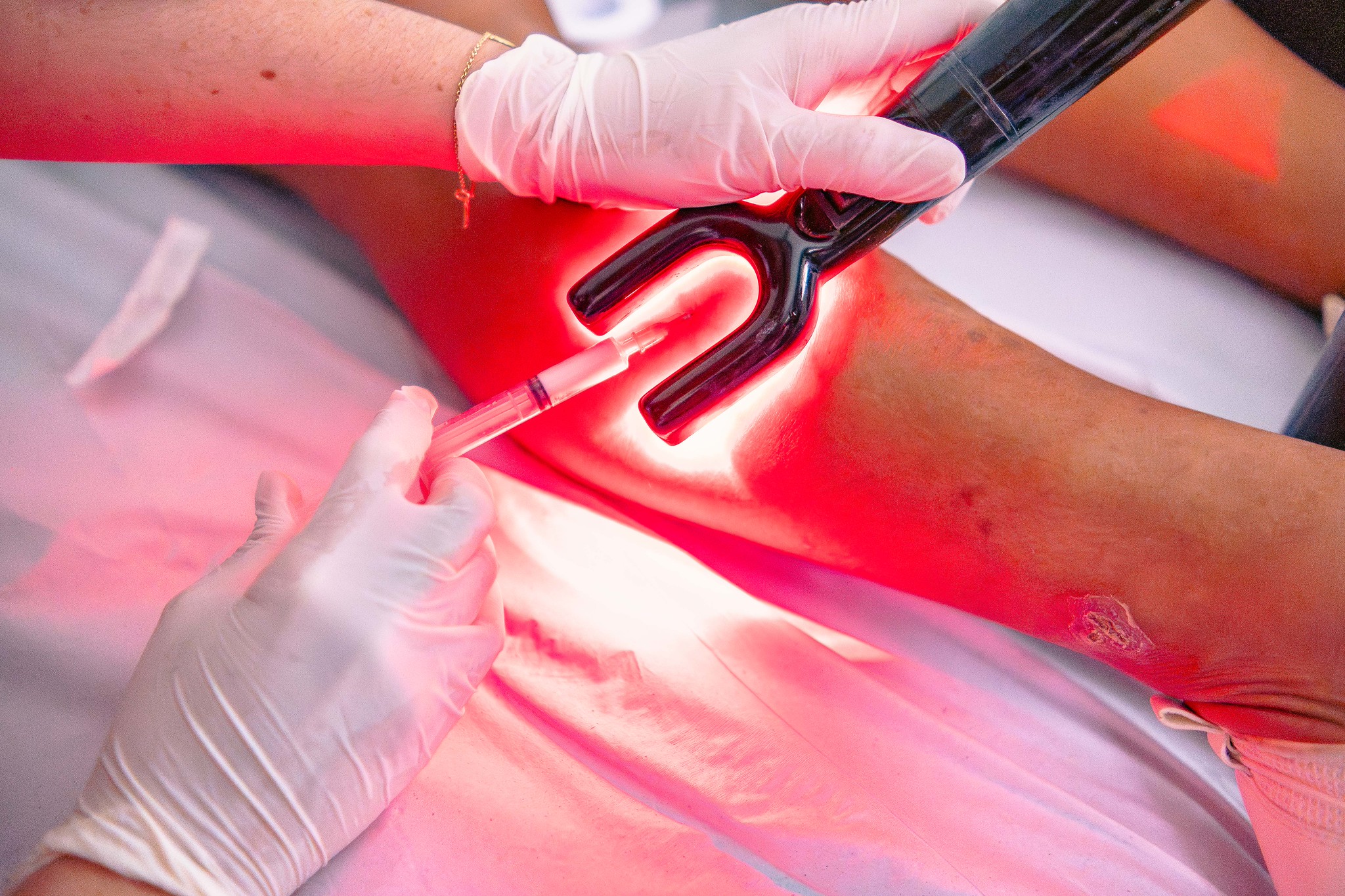 Bertioga promove ação intensificada para tratamento de varizes por escleroterapia